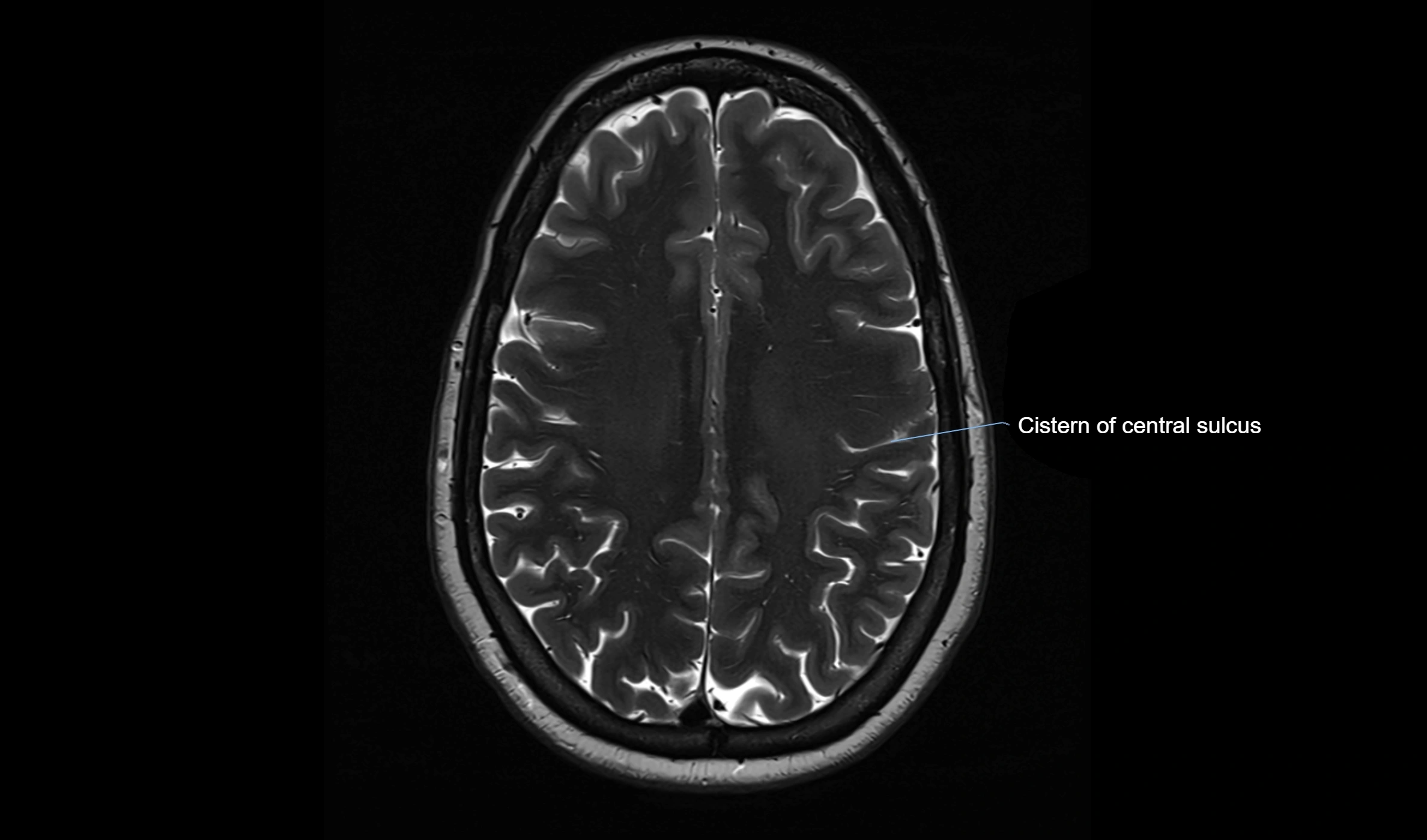 Brain cisterns  and ventricles  axial anatomy 3T MRI image-img-00001-00040.webp